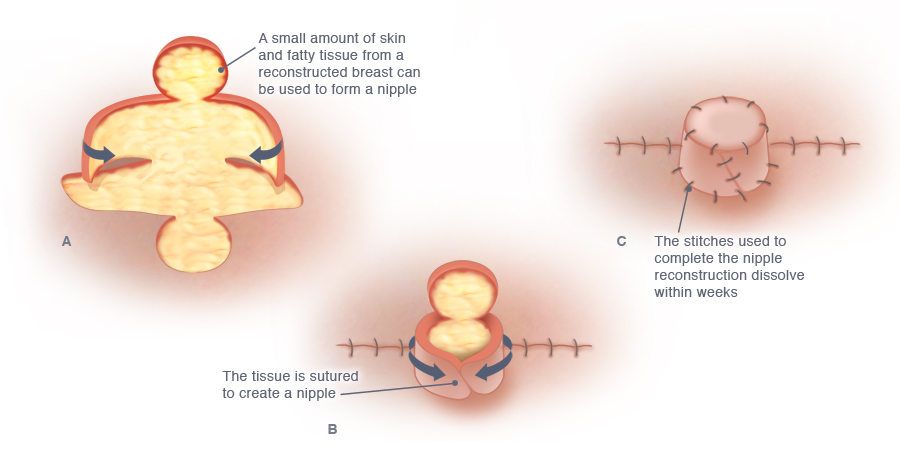 Nipple Reconstruction  The Plastic & Reconstructive Surgery Group