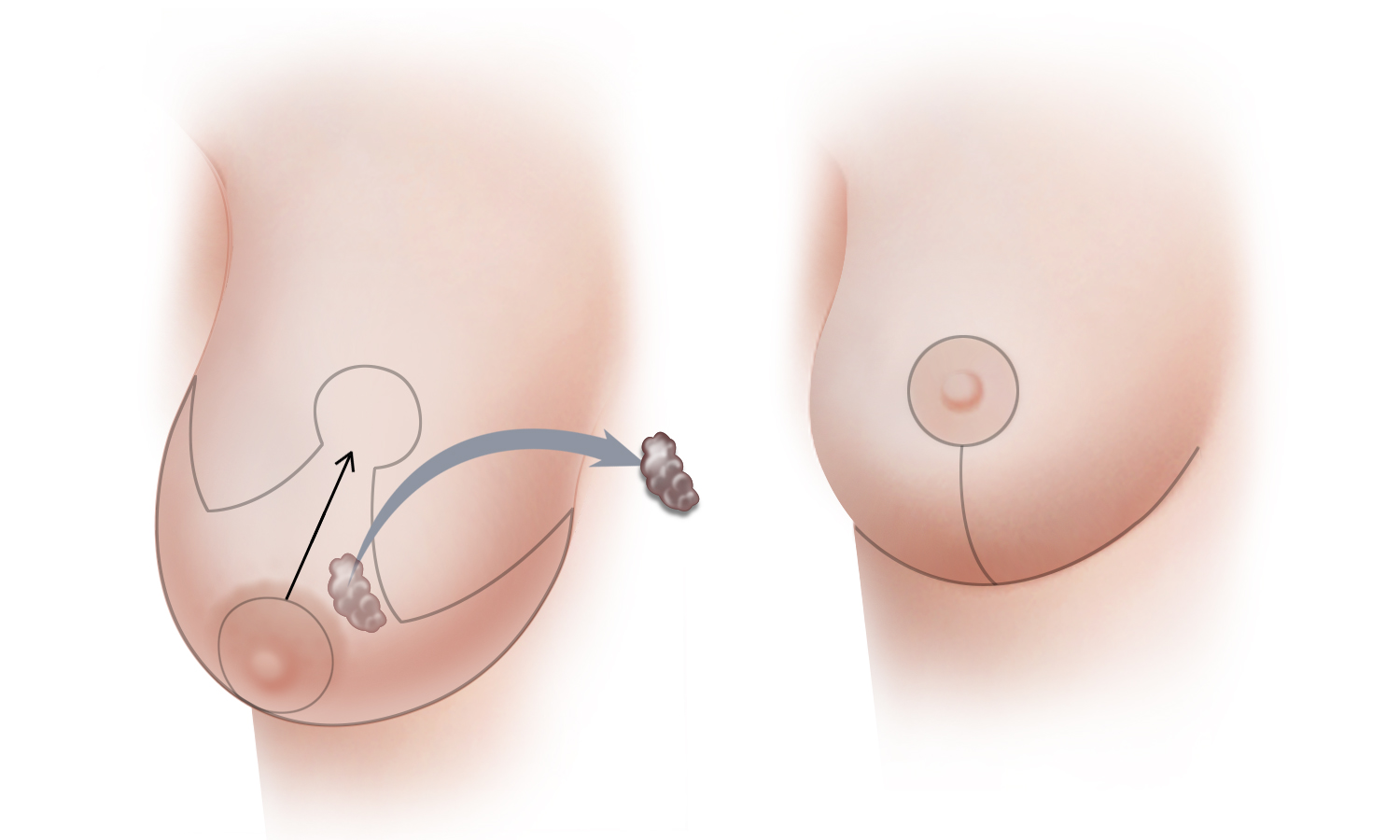 Breast lift (mastopexy) - series—Procedure: MedlinePlus Medical Encyclopedia