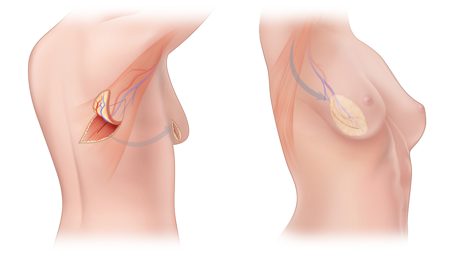 Surgical Compression Garments: DIEP Flap Breast Reconstruction, Revision  Phase