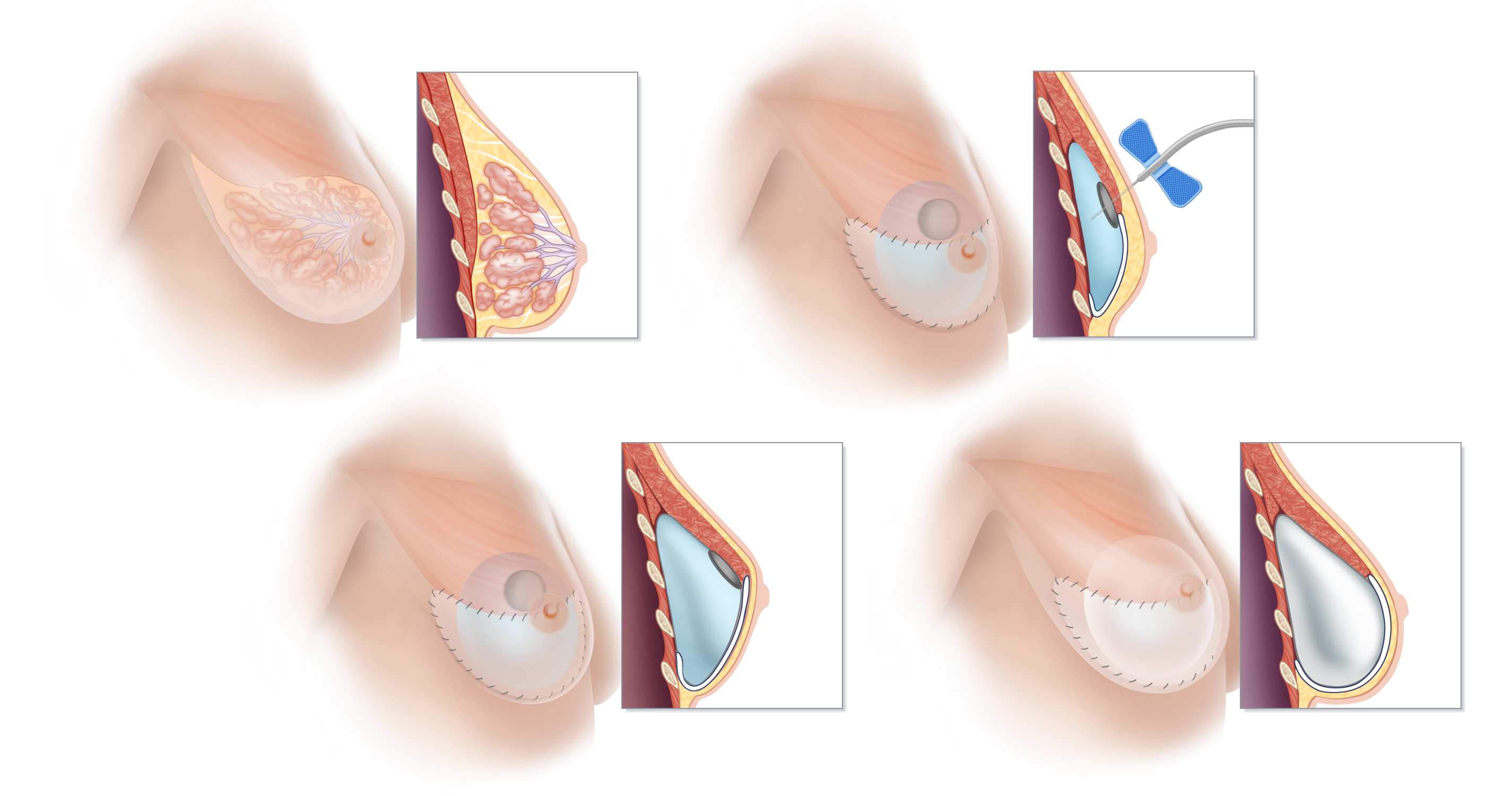Breast Implants Fairfield County, CT